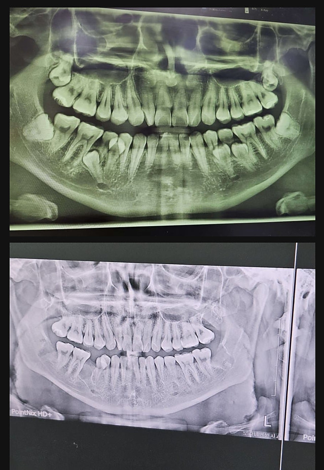 사랑니 갤러리 갤주